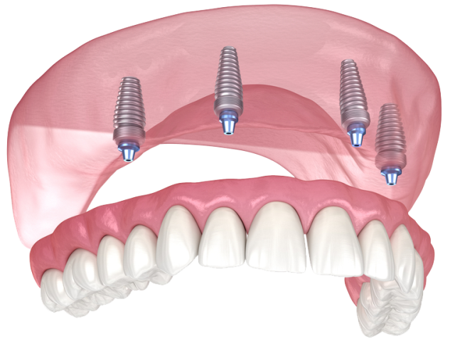 https://dentaltrip.co.uk/wp-content/uploads/2023/02/allon4-ust-640x493.png