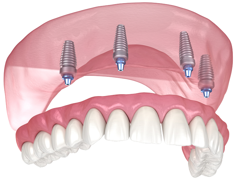 https://dentaltrip.co.uk/wp-content/uploads/2023/02/allon4-ust.png