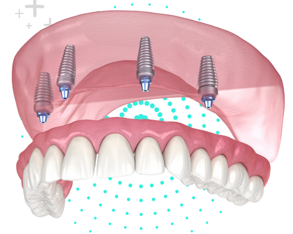 All On Four Implant System