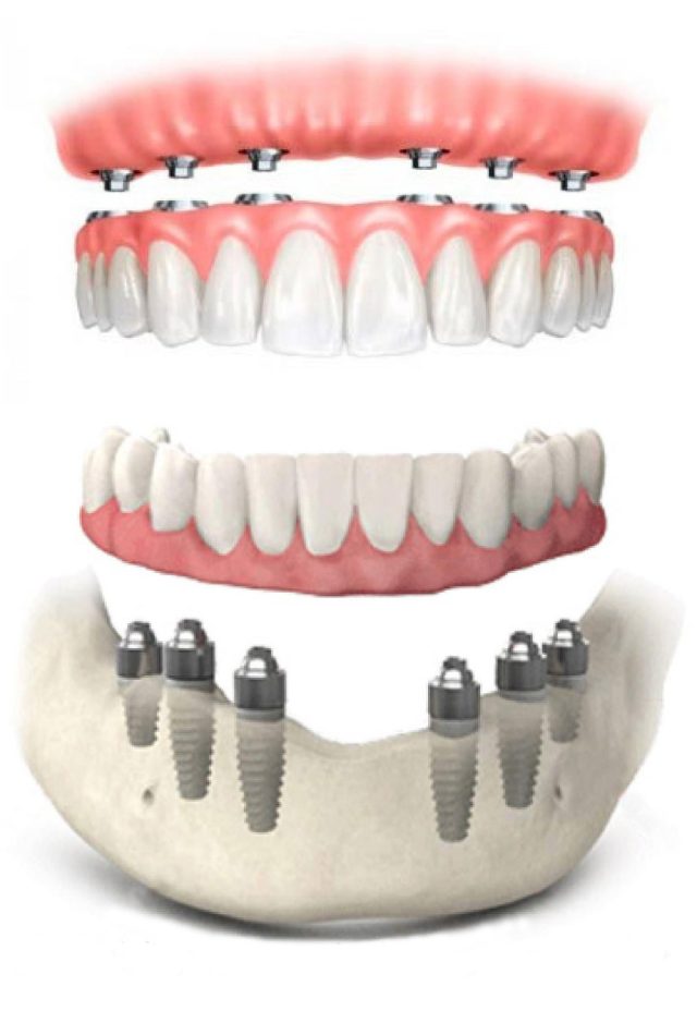 https://dentaltrip.co.uk/wp-content/uploads/2023/02/ao6-640x950.jpg