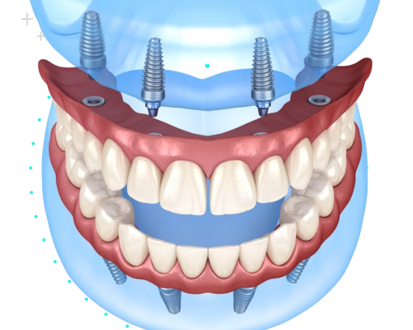 Full Mouth Implant System